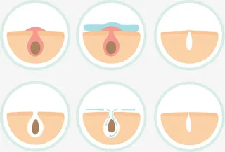 皮肤毛孔痘痘免抠