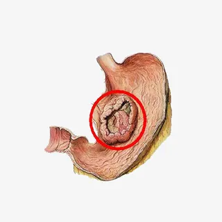 预防癌症病发免抠