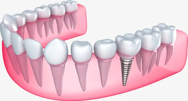 卡通种植牙模型免抠