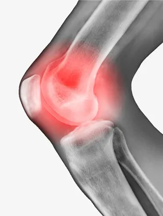 膝关节发炎免抠