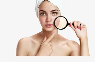 脸上长了痘免抠