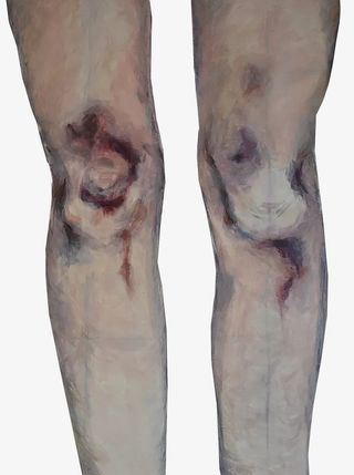 腿部淤青伤痕PNG免抠