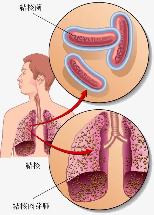 结核病结构免抠