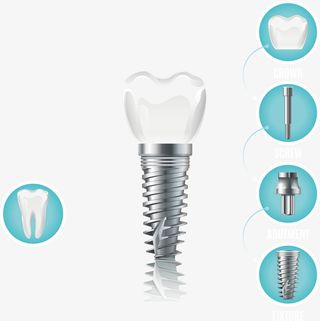 种植牙齿的配件下载免抠