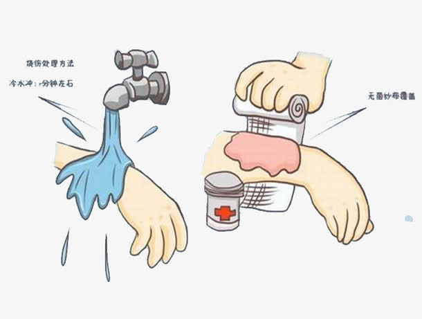 烧伤的正确处理方法免抠