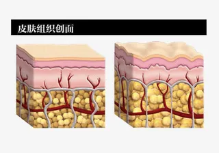 皮肤组织创面免抠