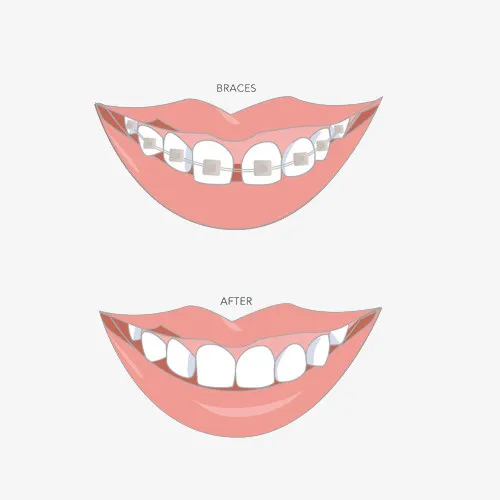 卡通矫正牙齿前后对比插画免抠免抠