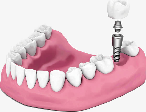 医院种植牙模型免抠