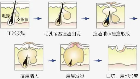 皮肤毛孔问题免抠