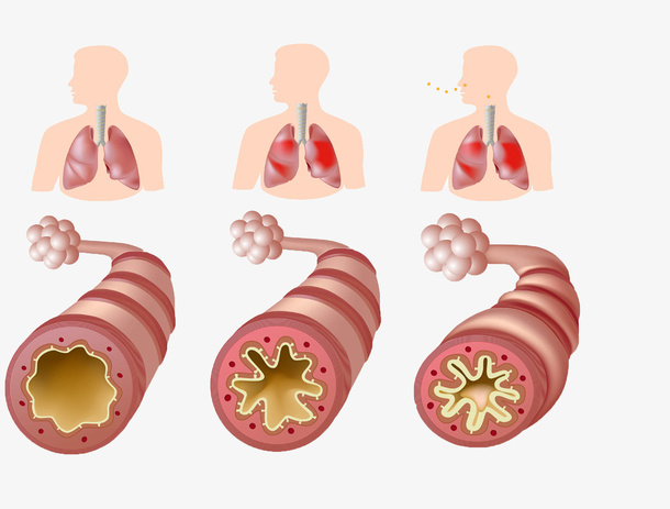 支气管哮喘免抠