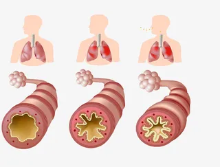 支气管哮喘免抠