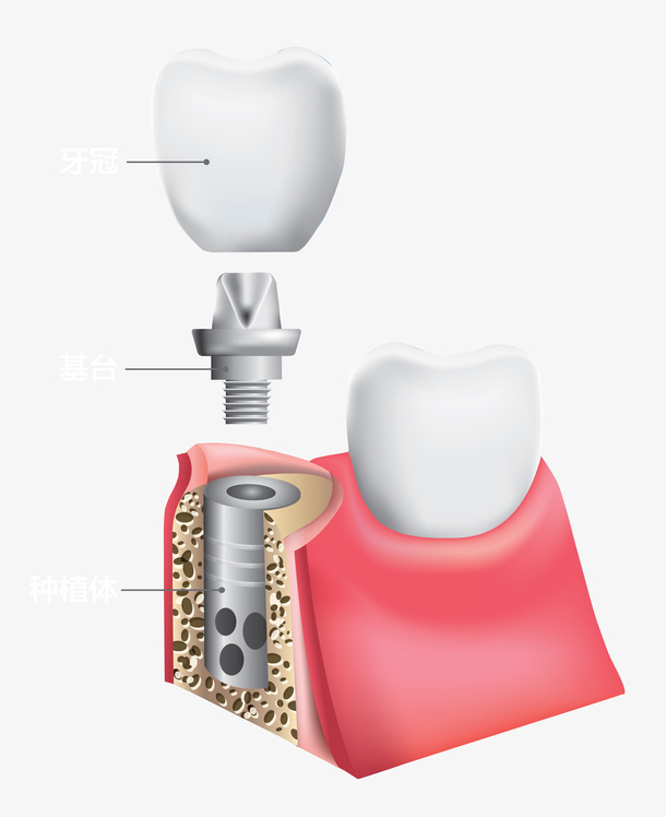 种植牙 牙齿 医院  基台  种植免抠