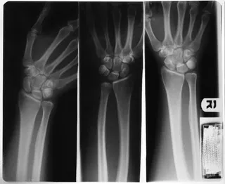 不同角度手部x光图像免抠