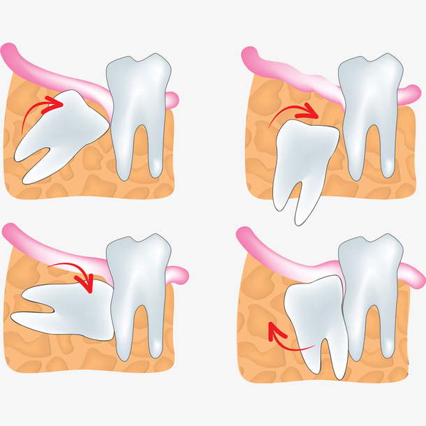 卡通四种智齿生长方向图示插画免免抠