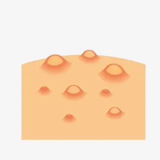 卡通皮肤水泡免抠