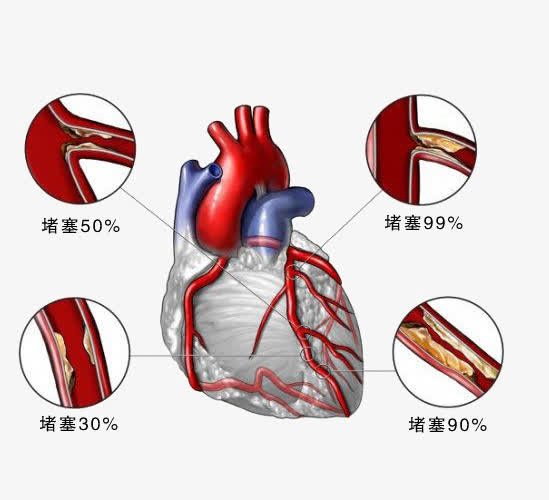 心脏疾病免抠