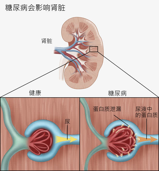 糖尿病会影响肾脏免抠