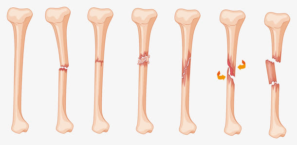 矢量骨折免抠
