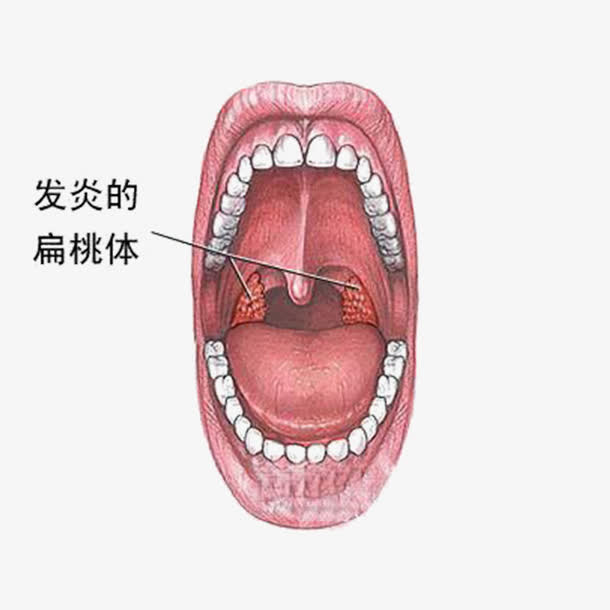 癌症的病变免抠
