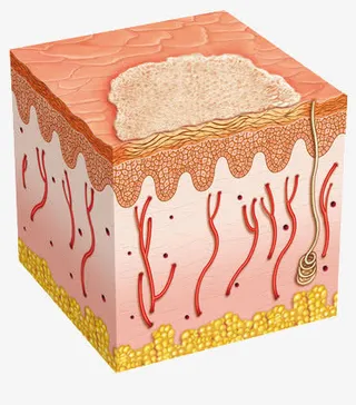 受损的皮肤免抠