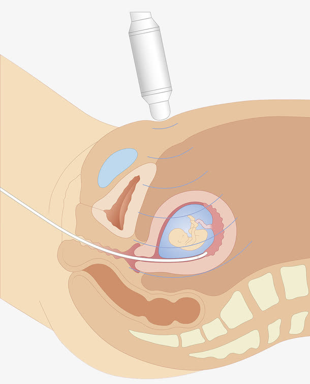 超声波胚胎探测免抠