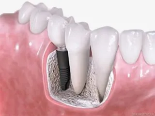 种植牙原理图免抠