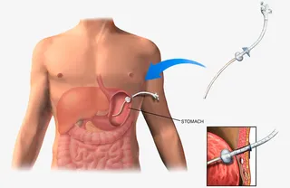 胃肠镜医疗插图免抠