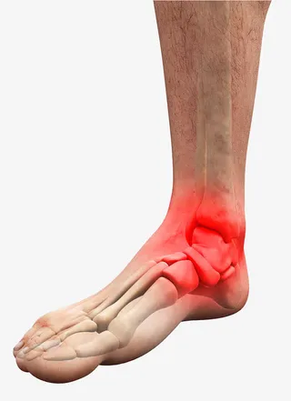 脚踝关节炎免抠