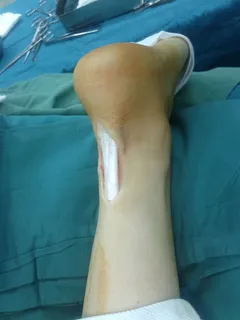 跟腱,肌腱,断裂,医学,解剖学,损伤,手术,腿 跟腱,肌腱,断裂,医学,解剖学,损伤,手术,腿