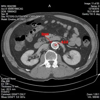 腹部、主动脉、动脉瘤、科学、生物学、心血管、解剖学、放大