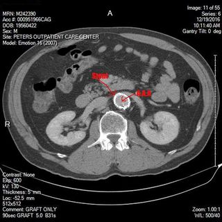腹部、主动脉、动脉瘤、科学、生物学、心血管、解剖学、放大