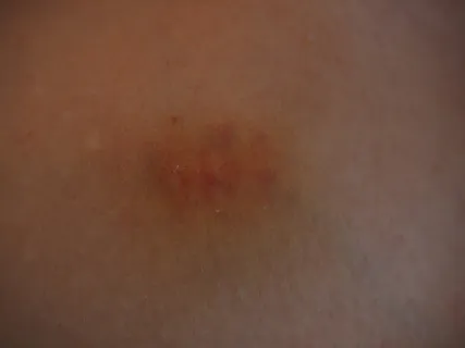 蓝斑、损伤、变色、皮肤、血肿、血肿、潮红、疼痛