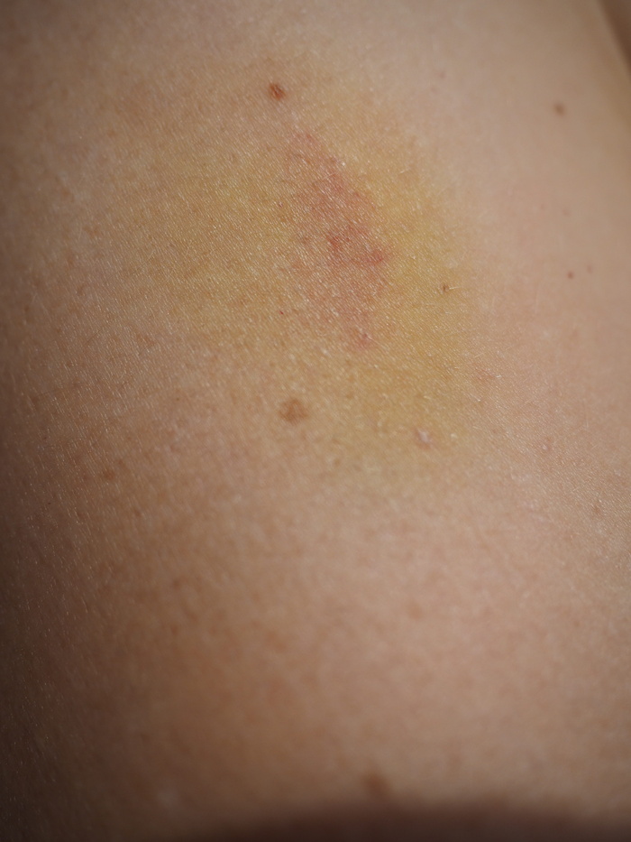 蓝斑、绿色、蓝色、血肿、变色、皮肤、黄色、血肿