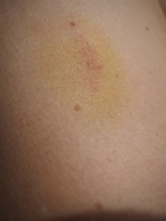 蓝斑、绿色、蓝色、血肿、变色、皮肤、黄色、血肿