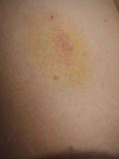 蓝斑、绿色、蓝色、血肿、变色、皮肤、黄色、血肿