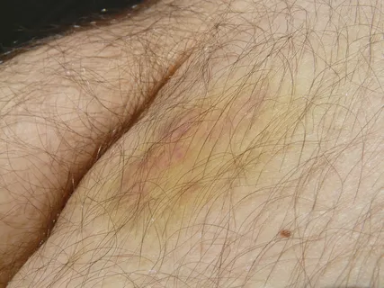 蓝斑、血肿、血肿、变色、绿色、黄色、皮肤、腿部