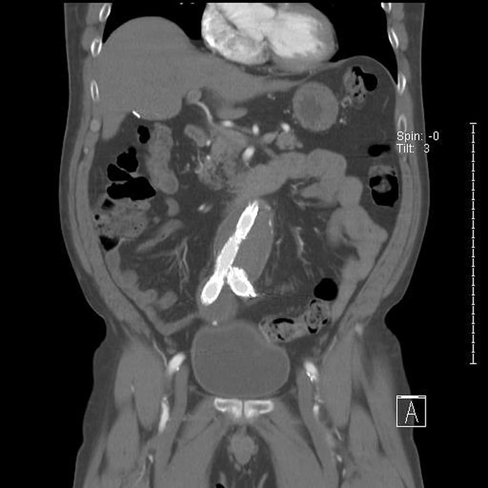 腹部、主动脉、动脉瘤、支架、catscan、X射线、医学、身体