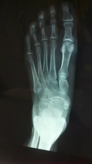 x光,左,脚,特写,照片,x光,骨骼,医用x光 x光,左,脚,特写,照片,x光,骨骼,医用x光