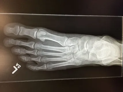 加拿大，科奎特兰，1286杜兰特医生，x光，足部，x光，骨骼，骨骼