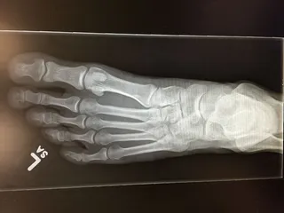 加拿大，科奎特兰，1286杜兰特医生，x光，足部，x光，骨骼，骨骼