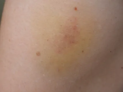 蓝斑、绿色、蓝色、血肿、变色、皮肤、黄色、血肿