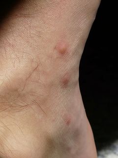 缝针、刺痛、瘙痒、注射部位、过敏反应、疣、风团、组胺