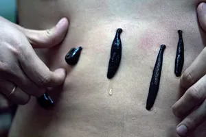 病人，治疗，水蛭疗法，治疗，药物，危险，寄生虫，治疗