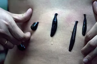 病人，治疗，水蛭疗法，治疗，药物，危险，寄生虫，治疗