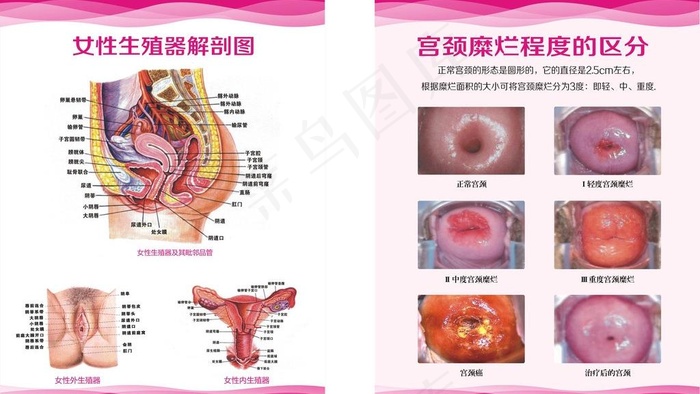 宫颈图 女性解剖图图片(600X800)cdr矢量模版下载