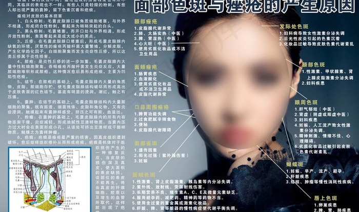 面部色斑与痤疮的产生原因图片(9250X6000(DPI:127))psd模版下载