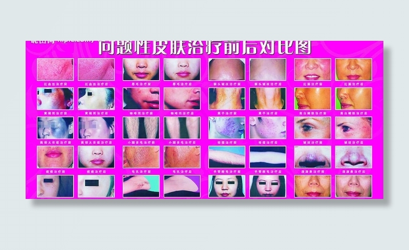 问题性皮肤治疗前后对比图图片