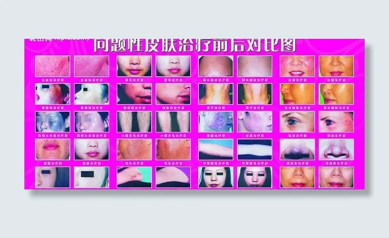 问题性皮肤治疗前后对比图图片cdr矢量模版下载