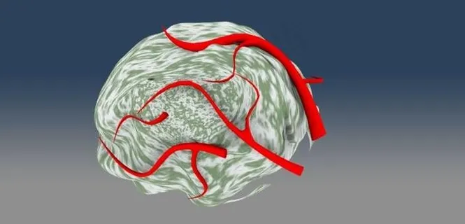 tumor_small W血管IC...