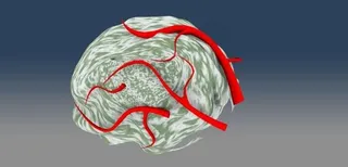 tumor_small W血管IC...